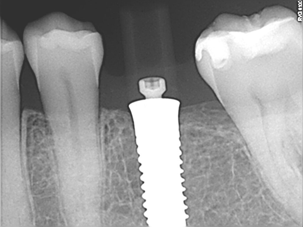 imagen de implante dental cerámico recién colocado