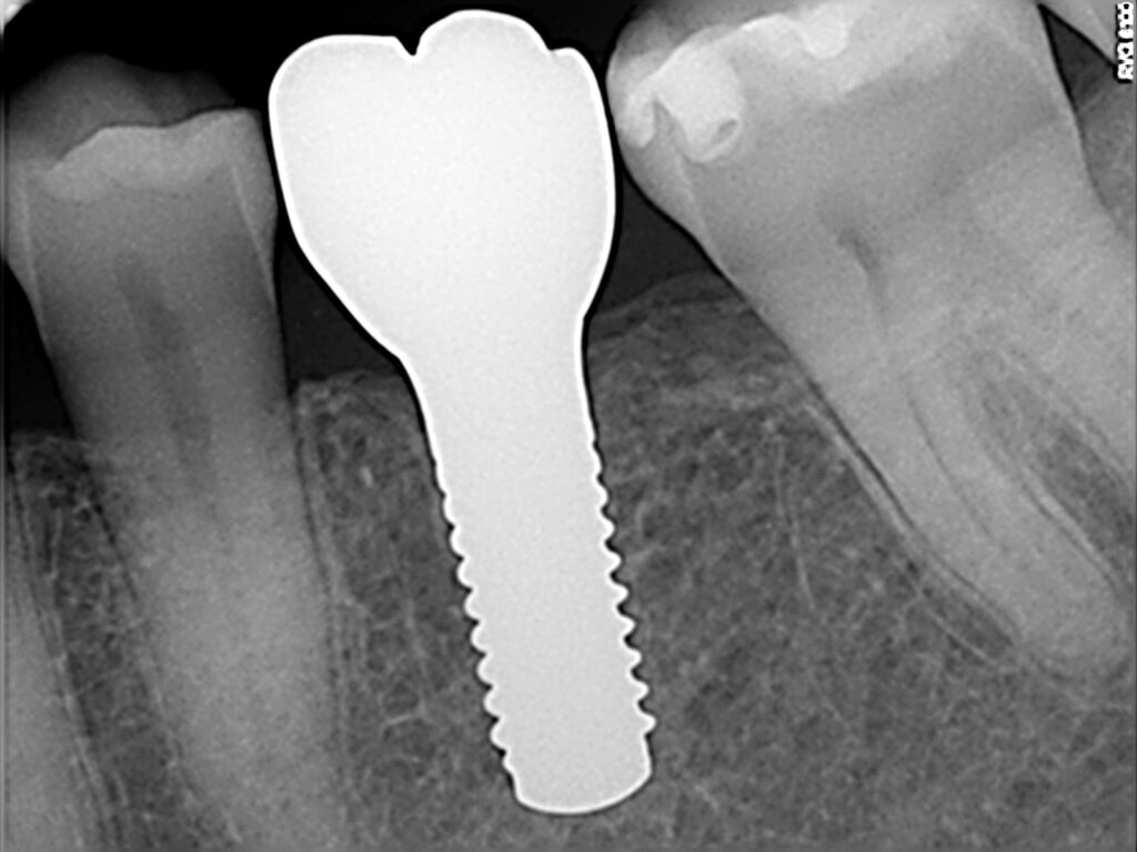 Radiografía de implante de zirconio con corona del mismo material