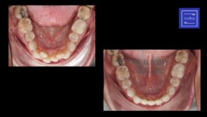 ortodoncia invisible : antes y después